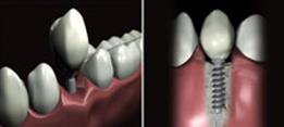 http://dr-diss-antoine.chirurgiens-dentistes.fr/dentiste/cms/upload/2_source/fiche/vignette_implantdentaire_casclinique.jpg