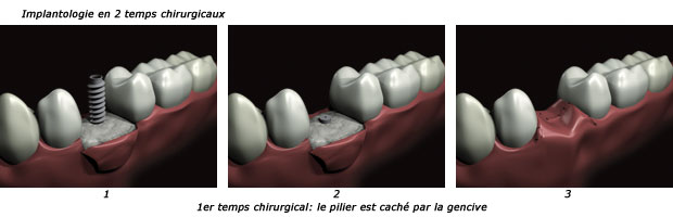 http://dr-diss-antoine.chirurgiens-dentistes.fr/dentiste/cms/upload/59_docteur-diss/fiche/implantologie-2t1-c.jpg