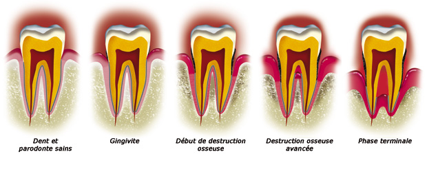 http://dr-diss-antoine.chirurgiens-dentistes.fr/dentiste/cms/upload/59_docteur-diss/fiche/maladie-paro-etap.jpg