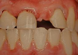 http://dr-diss-antoine.chirurgiens-dentistes.fr/dentiste/cms/upload/59_docteur-diss/fiche/pont00.jpg