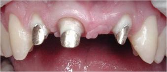 http://dr-diss-antoine.chirurgiens-dentistes.fr/dentiste/cms/upload/59_docteur-diss/fiche/pont%204.jpg