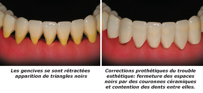 http://dr-diss-antoine.chirurgiens-dentistes.fr/dentiste/cms/upload/59_docteur-diss/fiche/gencives-retractees-2(1).jpg