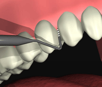 http://dr-diss-antoine.chirurgiens-dentistes.fr/dentiste/cms/upload/59_docteur-diss/fiche/etape4_sondeur-3.gif