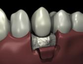 http://dr-diss-antoine.chirurgiens-dentistes.fr/dentiste/cms/upload/59_docteur-diss/fiche/comblement-2a1fiche5.gif