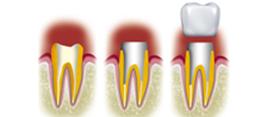 http://dr-diss-antoine.chirurgiens-dentistes.fr/dentiste/cms/upload/2_source/fiche/inlay-core.jpg