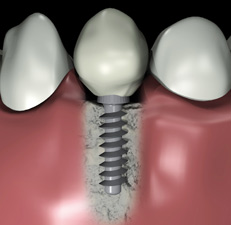 http://dr-diss-antoine.chirurgiens-dentistes.fr/dentiste/cms/upload/59_docteur-diss/fiche/coupe-implant12.jpg