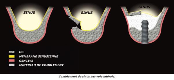 http://dr-diss-antoine.chirurgiens-dentistes.fr/dentiste/cms/upload/59_docteur-diss/fiche/sinus-lateral.jpg