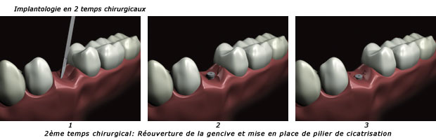 http://dr-diss-antoine.chirurgiens-dentistes.fr/dentiste/cms/upload/59_docteur-diss/fiche/implantologie-2t2-c(2).jpg