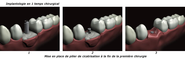 http://dr-diss-antoine.chirurgiens-dentistes.fr/dentiste/cms/upload/59_docteur-diss/fiche/implantologie-1t-c.jpg