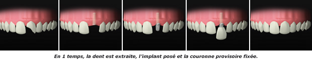 http://dr-diss-antoine.chirurgiens-dentistes.fr/dentiste/cms/upload/59_docteur-diss/fiche/dent-cassee.jpg