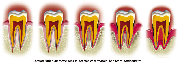 http://dr-diss-antoine.chirurgiens-dentistes.fr/dentiste/cms/upload/59_docteur-diss/fiche/etapes-tartre-c.jpg