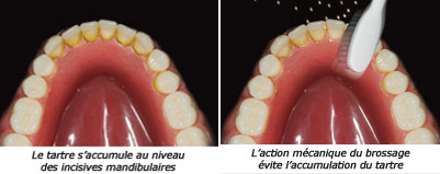 http://dr-diss-antoine.chirurgiens-dentistes.fr/dentiste/cms/upload/59_docteur-diss/fiche/fiche-tartre(1).jpg