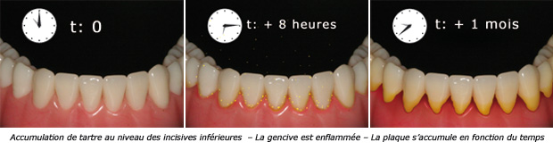 http://dr-diss-antoine.chirurgiens-dentistes.fr/dentiste/cms/upload/59_docteur-diss/fiche/plaque-dentaire55.jpg