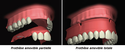 http://dr-diss-antoine.chirurgiens-dentistes.fr/dentiste/cms/upload/59_docteur-diss/fiche/prothese-partielle1.jpg