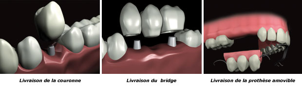 http://dr-diss-antoine.chirurgiens-dentistes.fr/dentiste/cms/upload/59_docteur-diss/fiche/prothese-livraison2-c(1).jpg