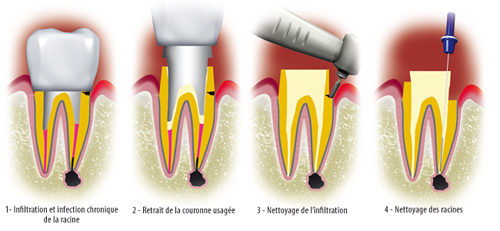 http://dr-diss-antoine.chirurgiens-dentistes.fr/dentiste/cms/upload/59_docteur-diss/fiche/couronne_carie(2).jpg