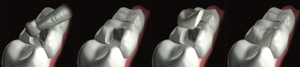 http://dr-diss-antoine.chirurgiens-dentistes.fr/dentiste/cms/upload/59_docteur-diss/fiche/prothese-indirect.jpg