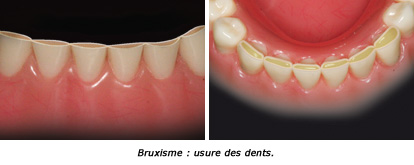 http://dr-diss-antoine.chirurgiens-dentistes.fr/dentiste/cms/upload/59_docteur-diss/fiche/bruxisme-12.jpg