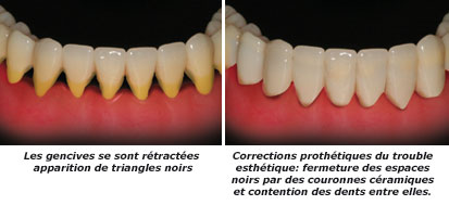 http://dr-diss-antoine.chirurgiens-dentistes.fr/dentiste/cms/upload/59_docteur-diss/fiche/gencives-retractees-2-c.jpg