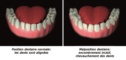 http://dr-diss-antoine.chirurgiens-dentistes.fr/dentiste/cms/upload/59_docteur-diss/fiche/malposition-1-c.jpg