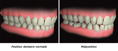 http://dr-diss-antoine.chirurgiens-dentistes.fr/dentiste/cms/upload/59_docteur-diss/fiche/malposition-2(2).jpg