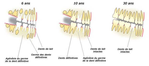 http://dr-diss-antoine.chirurgiens-dentistes.fr/dentiste/cms/upload/2_source/fiche/agenesie-c.jpg