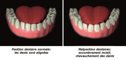 http://dr-diss-antoine.chirurgiens-dentistes.fr/dentiste/cms/upload/2_source/fiche/malposition-1.jpg