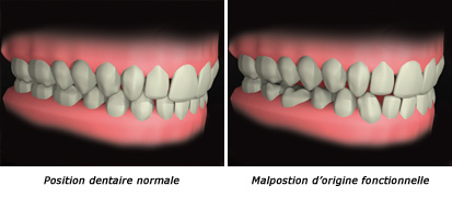 http://dr-diss-antoine.chirurgiens-dentistes.fr/dentiste/cms/upload/2_source/fiche/malposition-2.jpg