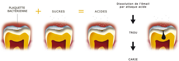 http://dr-diss-antoine.chirurgiens-dentistes.fr/dentiste/cms/upload/59_docteur-diss/fiche/3-1-formationcarie2.jpg