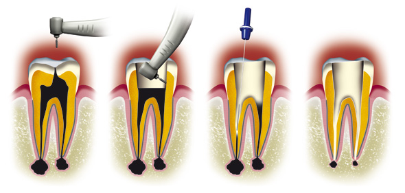 http://dr-diss-antoine.chirurgiens-dentistes.fr/dentiste/cms/upload/59_docteur-diss/fiche/devitalization1(2).jpg