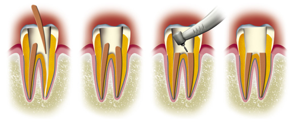 http://dr-diss-antoine.chirurgiens-dentistes.fr/dentiste/cms/upload/59_docteur-diss/fiche/devitalization2(3).jpg